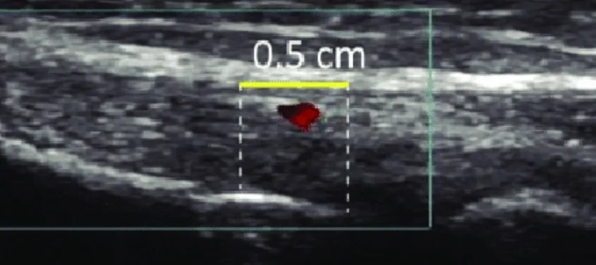 Echo acute peesontsteking fase 1