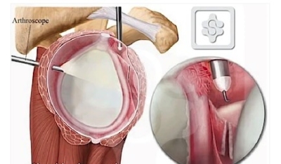 Anatomische illustratie van een artroscopische kapselrelease bij frozen shoulder: links een doorsnede van het schoudergewricht met de arthroscoop in het verdikt gewrichtskapsel, rechts een detailbeeld van het lossnijden van het verkleefde kapsel