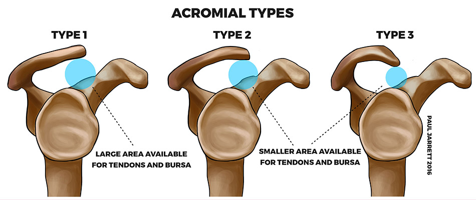 vernauwing van de schouder