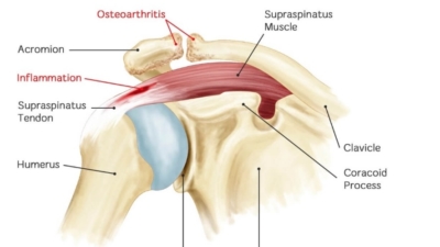 AC gewricht artrose en peesontsteking