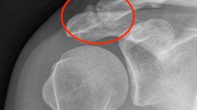 AC gewricht artrose rontgen