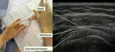 Echogeleide cortisone-injectie in de slijmbeurs van de schouder: links de naald in de schouder, rechts het echografisch beeld waarop de naald, de slijmbeurs en de supraspinatuspees zichtbaar zijn
