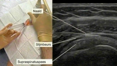 Echogeleide cortisone-injectie in de slijmbeurs van de schouder: links de naald in de schouder, rechts het echografisch beeld waarop de naald, de slijmbeurs en de supraspinatuspees zichtbaar zijn