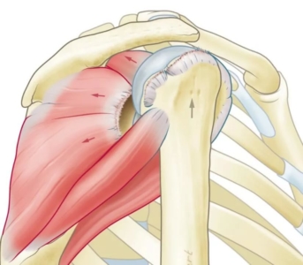 Anatomische illustratie van cuff artropathie: de schouderkop is omhoog geschoven door de gescheurde en teruggetrokken rotator cuff pezen, de pijlen tonen de richting van terugtrekking en de opwaartse verschuiving van de schouderkop