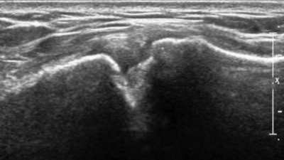 Echo AC gewricht Artrose