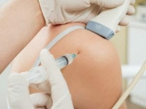 Echogeleide injectie bij een cuff ruptuur: de echokop op de schouder en de naald wordt onder begeleiding van echografie in de slijmbeurs geplaatst