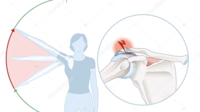 Illustratie van schouder-inklemming: de pijnlijke boog bij het heffen van de arm (rood gemarkeerd) met een anatomisch detail van de ingeklemde slijmbeurs en schouderpezen onder het schouderdak