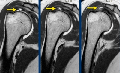 MRI-beelden van een cuff ruptuur in drie opeenvolgende coupes: de gele pijlen wijzen op het defect in de supraspinatuspees, zichtbaar als een witte onderbreking in het peesweefsel boven de schouderkop