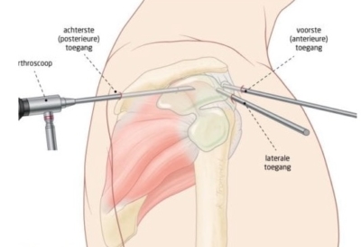 Illustratie van een arthroscopische schouderoperatie: de arthroscoop en instrumenten worden via drie toegangen (posterieur, anterieur en lateraal) in de schouder ingebracht
