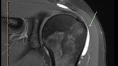 <p>Op een MRI is de slijmbeurs wel goed zichtbaar — zeker als er vocht in zit. Maar voor de diagnose en behandeling van een slijmbeursontsteking voegt een MRI zelden iets toe aan wat we al zien op echo.</p><p>” width=”400″ height=”225″ /></p><p>Maar voor de diagnose en behandeling van een slijmbeursontsteking voegt een MRI zelden iets toe aan wat we al zien op echo.</p><h4>Waarom echo beter is bij slijmbeursklachten</h4><p>De slijmbeurs, pezen en kalkafzettingen liggen aan de buitenkant van de schouder, niet verscholen achter bot. Daardoor brengt een goede echo deze structuren scherper in beeld dan een MRI. De resolutie is hoger en u kunt het beeld sterk vergroten.</p><p>Bovendien biedt echo voordelen die MRI niet heeft:</p><ul><li><strong>Dynamisch onderzoek:</strong> we zien de slijmbeurs en pezen tijdens het bewegen. Klemmen ze? Glijden ze soepel?</li><li><strong>Direct resultaat:</strong> tijdens hetzelfde consult diagnose én behandeling</li><li><strong>Vergelijking:</strong> we kunnen direct de gezonde schouder ernaast leggen</li></ul><h4>Het enige nadeel van echo</h4><p>Met echo kunnen we niet ín het schoudergewricht kijken. Geluidsgolven gaan niet door bot heen. Maar gewrichtsaandoeningen veroorzaken eigenlijk geen slijmbeursproblemen. Voor een slijmbeursontsteking mist u dus niets.</p><h4>Wanneer vragen we wél een MRI aan?</h4><ul><li><strong>Vermoeden van een labrumscheur:</strong> het labrum (kraakbeenrand) ligt achter de botkop en is niet zichtbaar op echo</li><li><strong>Intra-articulaire laesie:</strong> schade bínnen het gewricht die we met echo niet kunnen beoordelen</li><li><strong>Operatieplanning:</strong> bij een schouder pees scheur (rotator cuff) die mogelijk geopereerd moet worden</li><li><strong>Langdurig beloop zonder verbetering:</strong> om andere oorzaken uit te sluiten</li></ul><div style=