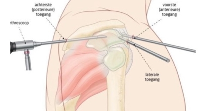 Slijmbeursontsteking schouder operatie