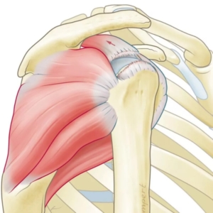 Anatomische illustratie van een teruggetrokken supraspinatuspees na cuff ruptuur: de pees is volledig afgescheurd en heeft zich teruggetrokken van de schouderkop