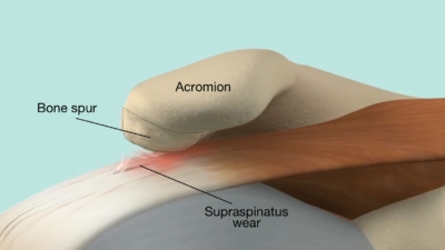 Anatomische illustratie van botaangroei (bone spur) onder het acromion die druk geeft op de supraspinatus schouderpees