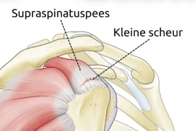 Anatomische illustratie van een cuff ruptuur: een scheur zichtbaar in de supraspinatuspees op de aanhechting aan de schouderkop