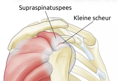 cuff ruptuur (gescheurde schouder pees)