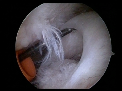 Arthroscopisch beeld van een debridement bij een cuff ruptuur: het freesinstrument verwijdert de rafelige en beschadigde randen van de gescheurde schouderpees