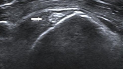 diffuse kalkafzetting een schouder pees en scheurtje