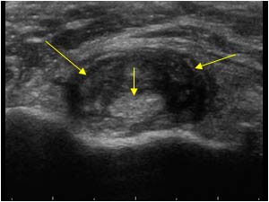 Echografisch beeld van de bicepspees in de schouder: de gele pijlen wijzen op vocht rondom de peesschede, een teken van bicepspees ontsteking