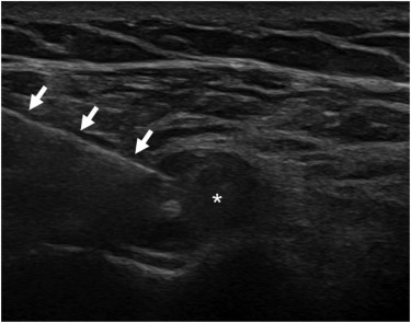 Echografisch beeld van een echogeleide cortisone injectie in de peesschede rondom de bicepspees in de schouder — de witte pijlen tonen de naald, het sterretje de bicepspees