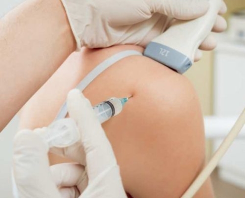 Echogeleide injectie in de schouder: de echokop wordt op de schouder geplaatst terwijl de naald echogeleid in het schoudergewricht wordt gebracht voor de behandeling van artrose