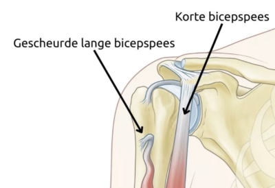 Anatomische illustratie van een gescheurde lange bicepspees in de schouder: de pees hangt los terwijl de korte bicepspees intact blijft