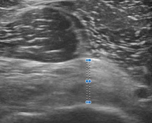 Echografisch beeld van een gezwollen gewrichtskapsel bij frozen shoulder: de meetpunten tonen de dikte van het verdikt en ontstoken schouderkapsel