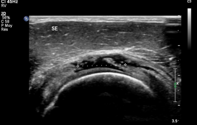 Echografisch beeld van een volledige cuff ruptuur: de meetpunten tonen de breedte van het defect in de supraspinatuspees, met daarboven de gevulde slijmbeurs (SE) zichtbaar als een donkere zone