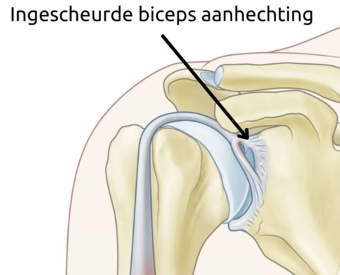 Anatomische illustratie van een ingescheurde aanhechting van de bicepspees aan het labrum van de schouder, ook wel SLAP-laesie genoemd