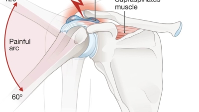 Illustratie van schouderinklemming: de slijmbeurs en supraspinatus schouderpees knellen tegen het acromion bij het heffen van de arm tussen 60 en 120 graden
