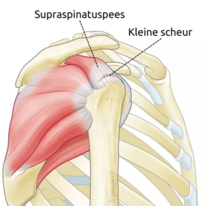 Anatomische illustratie van een kleine cuff ruptuur in de supraspinatuspees: een klein scheurtje zichtbaar aan de aanhechting op de schouderkop