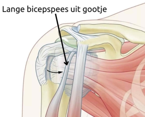 Anatomische illustratie van een instabiele lange bicepspees die uit het gootje van de schouderkop is geschoten