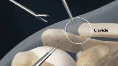 Arthroscopische laterale clavicula resectie: chirurgische instrumenten verwijderen het uiteinde van het sleutelbeen (clavicle) via kleine insteekopeningen in de schouder
