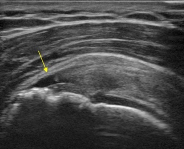 Echografisch beeld van een partiële cuff ruptuur: de gele pijl wijst op het zwarte defect in de supraspinatuspees, zichtbaar als een donkere onderbreking in het peesweefsel