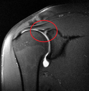 MRI-arthrogram van de schouder met een SLAP-laesie: de rode cirkel toont de ingescheurde aanhechting van de bicepspees aan het labrum van de schouderkom