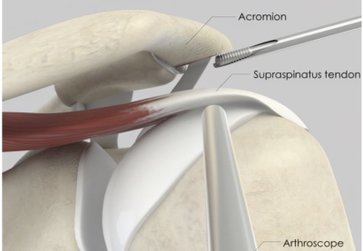 Arthroscopische neerplastiek: het schouderdak (acromion) wordt via een kijkoperatie bijgewerkt met een frees, met zicht op de supraspinatus schouderpees