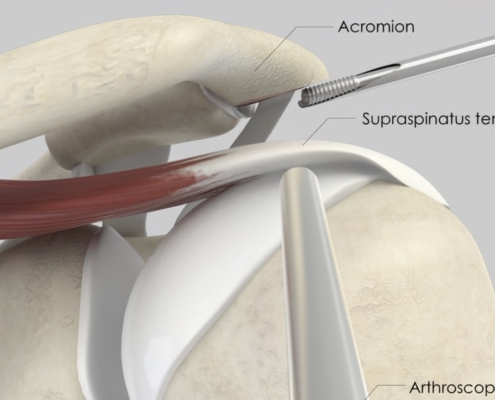 Arthroscopische neerplastiek: het schouderdak (acromion) wordt via een kijkoperatie bijgewerkt met een frees, met zicht op de supraspinatus schouderpees