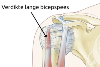 Anatomische illustratie van een verdikte en ontstoken lange bicepspees in het gootje van de schouder — kenmerkend bij biceps tendinitis of biceps tendinopathie