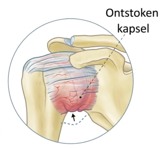 Anatomische illustratie van een ontstoken gewrichtskapsel bij frozen shoulder: het rode, gezwollen kapsel rondom de schouderkop met toegenomen doorbloeding, kenmerkend bij adhesieve capsulitis