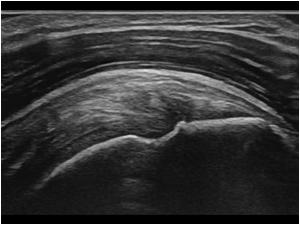 peesontsteking echografie