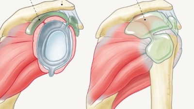 peesontsteking schouder