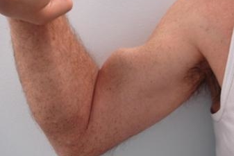  Klinische foto van het Popeye-teken: de bicepsspier is naar beneden gezakt na een volledige scheur van de lange bicepspees in de schouder