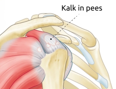 Anatomische illustratie van een kalkafzetting in de supraspinatuspees van de schouder, zichtbaar als witte vlekken in het peesweefsel onder het schouderdak