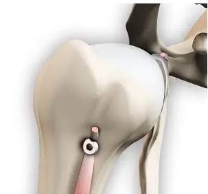 Anatomische illustratie van een biceps tenodese: de lange bicepspees wordt met een schroef verankerd in de bovenarm, zodat de pees niet meer in het gootje schuurt