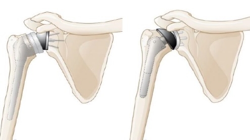 Illustratie van twee typen schouderprothesen naast elkaar: links de anatomische schouderprothese met metalen kop op de bovenarm, rechts de omgekeerde schouderprothese met de bol op het schouderblad