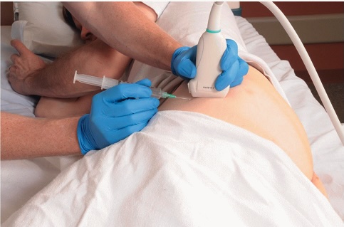Echogeleide cortisone-injectie bij slijmbeursontsteking heup: naald en echosonde zichtbaar aan de buitenkant van de heup
