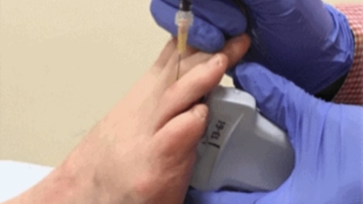 Echogeleide injectie bij een Mortons neuroom: de naald wordt op het scherm gevolgd tot naast de zenuw tussen de middenvoetsbeentjes